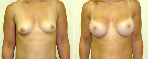 Before and After Breast Augmentation Female Patient Front Angle View Case 993