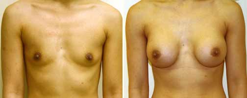 Before and After Breast Augmentation Female Patient Front Angle View Case 995