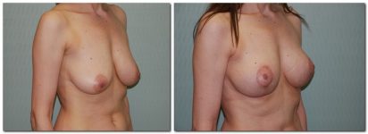 before and after Breast Lift diagonal angle view Case 919