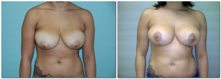 before and after Breast Lift female patient front angle view Case 915