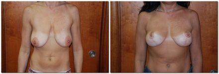 before and after Breast Lift front angle view Case 923