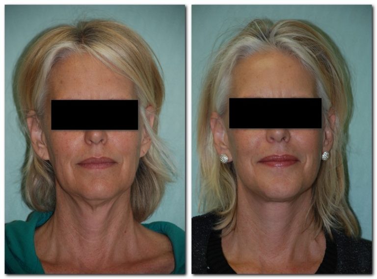before and after Facelift / Neck Lift front angle view Case 2459