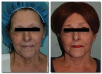 before and after Facelift / Neck Lift front angle view Case 2476