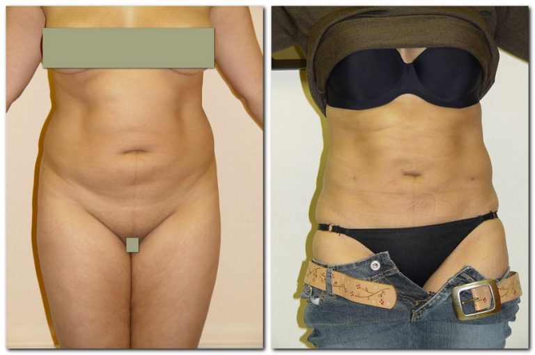 Before and After Liposuction Female Patient Front Angle View Case 2328