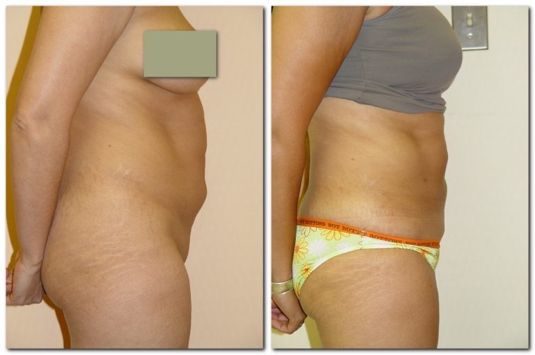 Before and After Liposuction Female Patient Side Angle View Case 2331