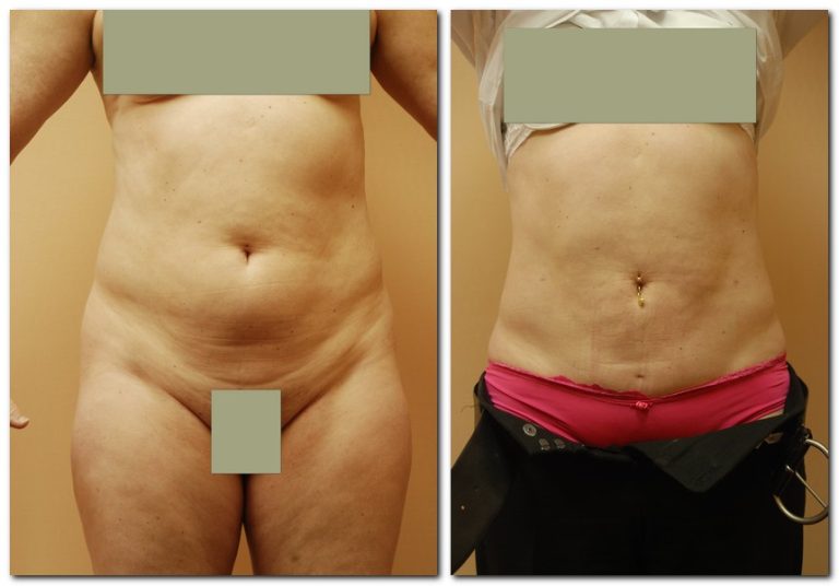 Before and After Liposuction Female Patient Front Angle View Case 2337