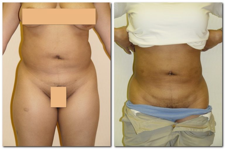 Before and After Liposuction Female Patient Front Angle View Case 2342