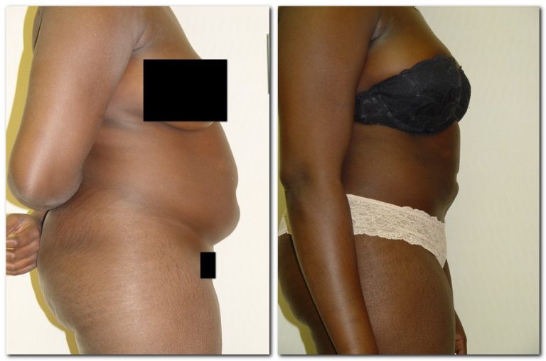 Before and After Liposuction Female Patient Side Angle View Case 2344