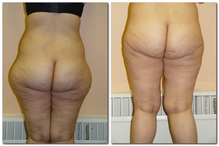 Before and After Liposuction Female Patient Back Angle View Case 2346