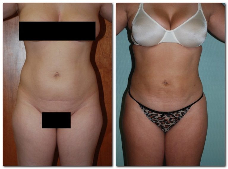 Before and After Liposuction Female Patient Front Angle View Case 2350