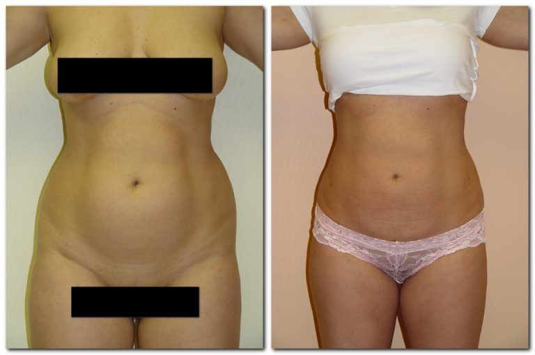 before and after Liposuction female patient front view Case 2354