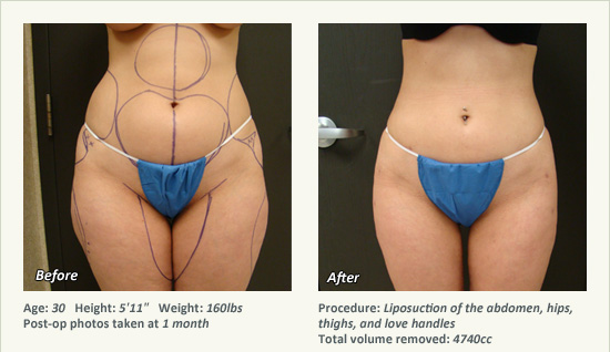 Liposuction Recovery: Depression After Liposuction