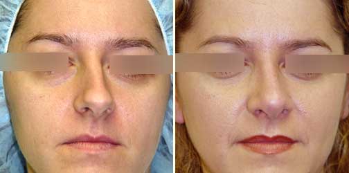 before and after Rhinoplasty female patient front angle view Case 949