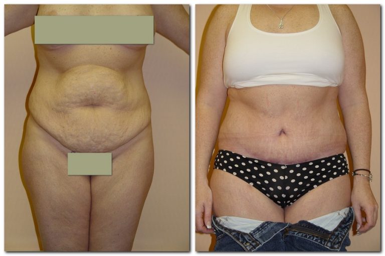 before and after Tummy Tuck female patient front angle view Case 2393