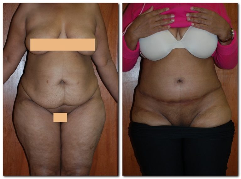 before and after Tummy Tuck front angle view Case 2403